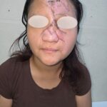 RECONSTRUYE UMAE DEL IMSS VERACRUZ NORTE NARIZ Y ROSTRO DE KATIA FRANCELYNE