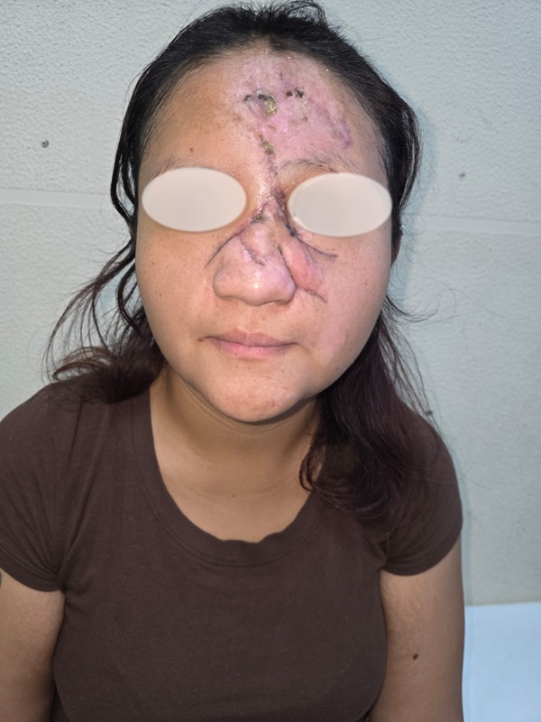RECONSTRUYE UMAE DEL IMSS VERACRUZ NORTE NARIZ Y ROSTRO DE KATIA FRANCELYNE